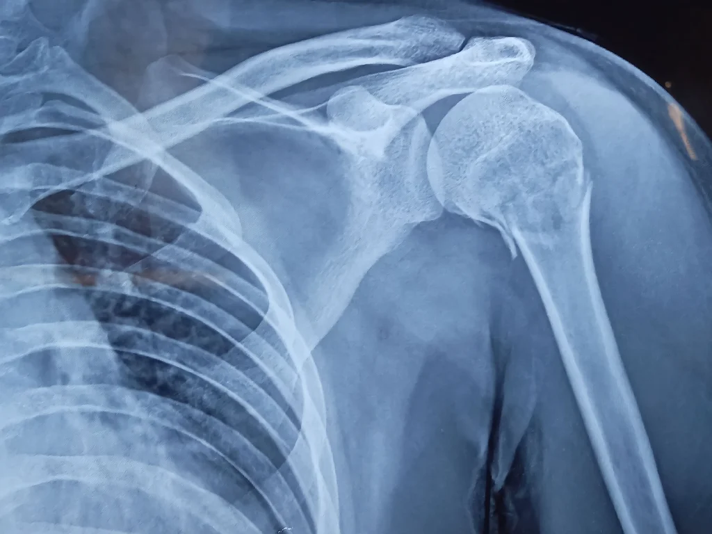 Shoulder Fracture Treatment in Coachella Valley | Spencer Orthopedics